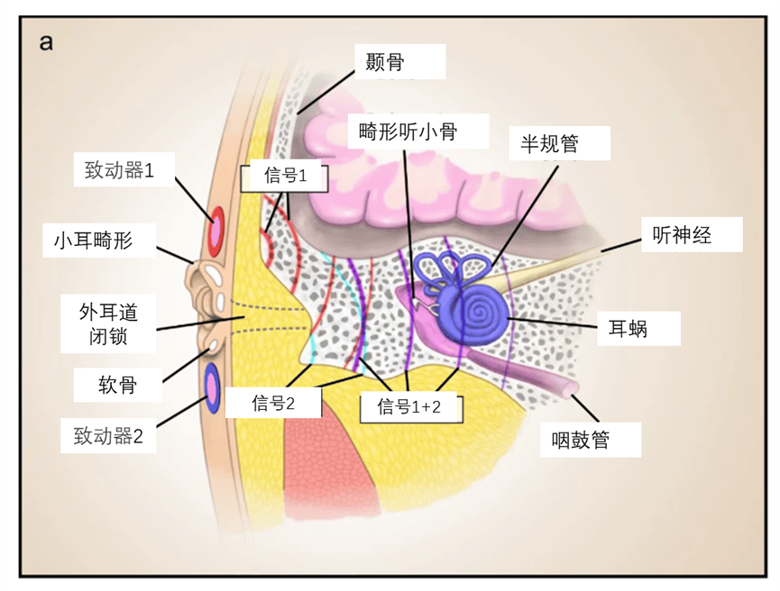 Flexible Skin-Mounted Device Explored for Conductive Hearing Loss